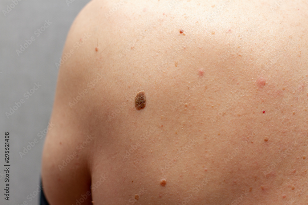 large moles on the back of a person large moles on the back of a person