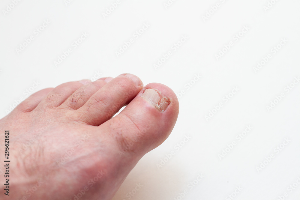 foot nail damaged by fungus foot nail damaged by fungus