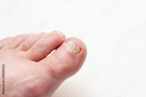male foot with toenail fungus on white background © epovdima