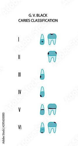 Caries type classification black six hand drawn vector illustration in cartoon comic style