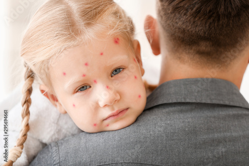 Man taking care of his little daughter ill with chickenpox at home