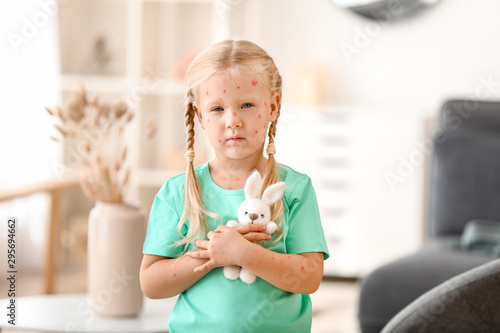 Little girl ill with chickenpox at home