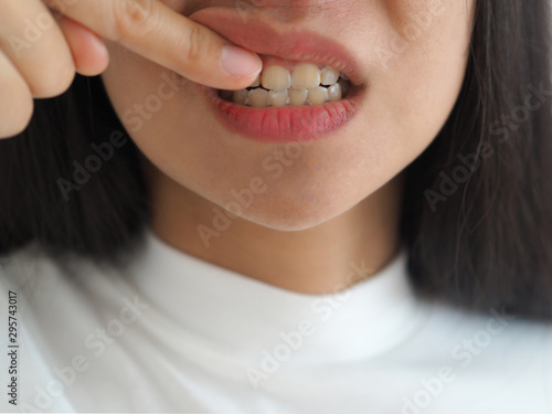 calculus teeth in asian woman. She use finger pointing her tooth use for dental scaling or toothbrush and toothpaste product
