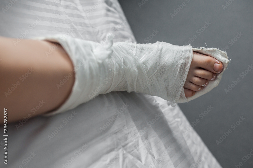 Broken leg in white plaster lies on the bed