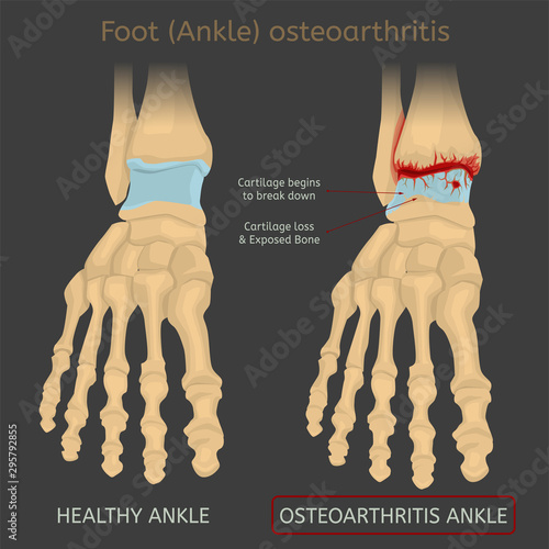 Foot arthritis image