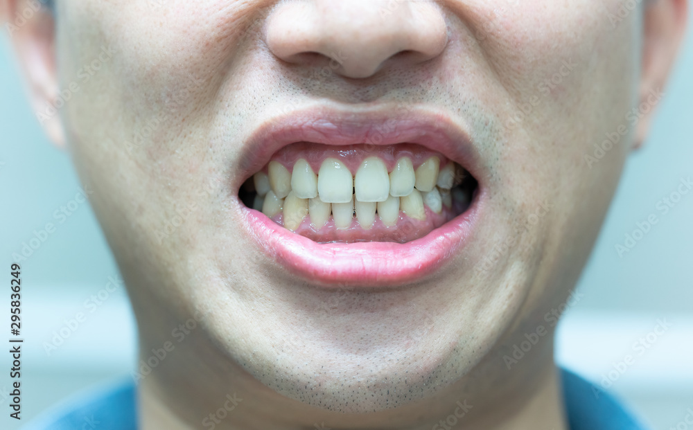 Fototapeta premium man grin a teeth AFTER a teeth cleaning Dental health care. He had my teeth cleaned