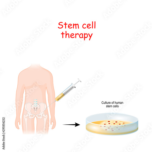 Stem cell therapy