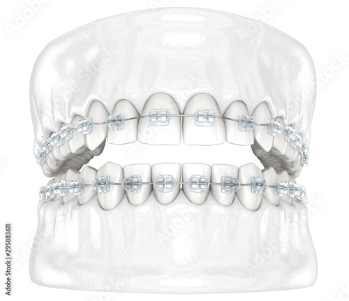 Teeth and Clear braces. Medically accurate dental 3D illustration photo