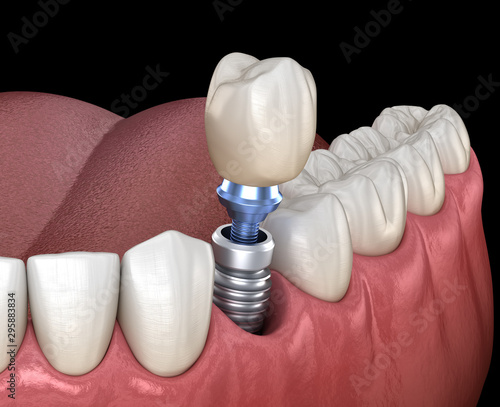 Premolar tooth recovery with implant. Medically accurate 3D illustration of human teeth and dentures concept