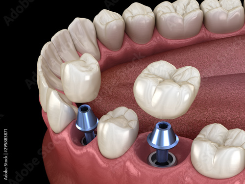 Premolar and Molar tooth crown installation over implant - concept. 3D illustration of human teeth and dentures