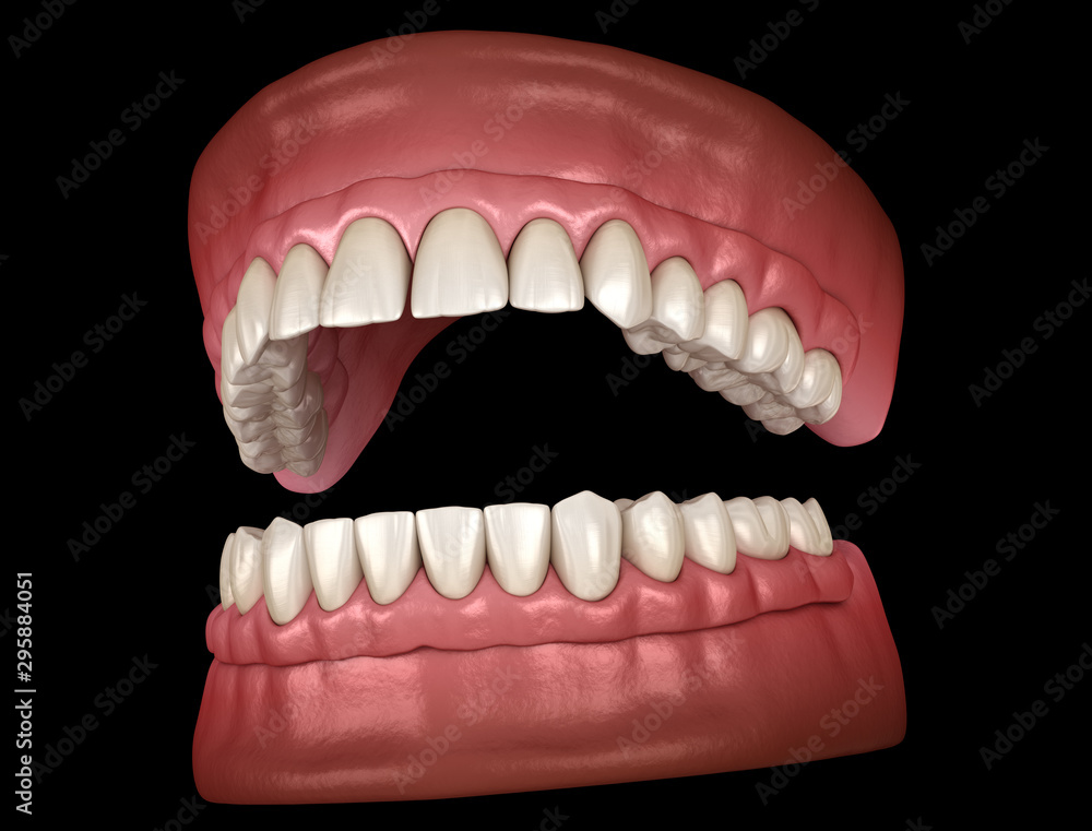 Naklejka premium Maxillary and Mandibular prosthesis with gum All on 4 system supported by implants. Medically accurate 3D illustration of human teeth and dentures