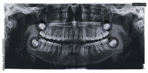 Dental x-ray for teeth surgery with the rudiments of wisdom teeth