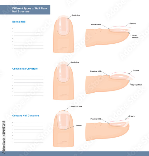 Different Types of Nail Plate. Normal, Convex and Concave Nails. Nail Extension Guide. Vector Illustration photo