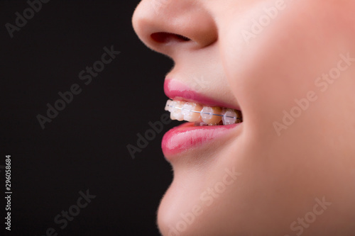 Braces. Beautiful Woman healthy smile close up. Closeup Ceramic Braces on Teeth. Beautiful Female Smile with Braces. Orthodontic Treatment. Beautiful Lips and Teeth