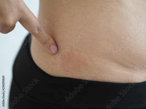 Tapet heat rash or prickly heat or miliaria in asian woman and pointing her waist skin