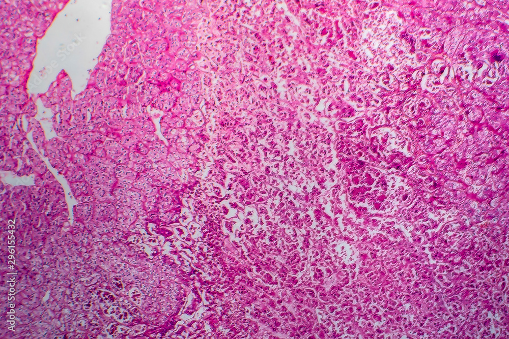 Renal cell carcinoma, light micrograph, photo under microscope Renal cell carcinoma, light micrograph, photo under microscope