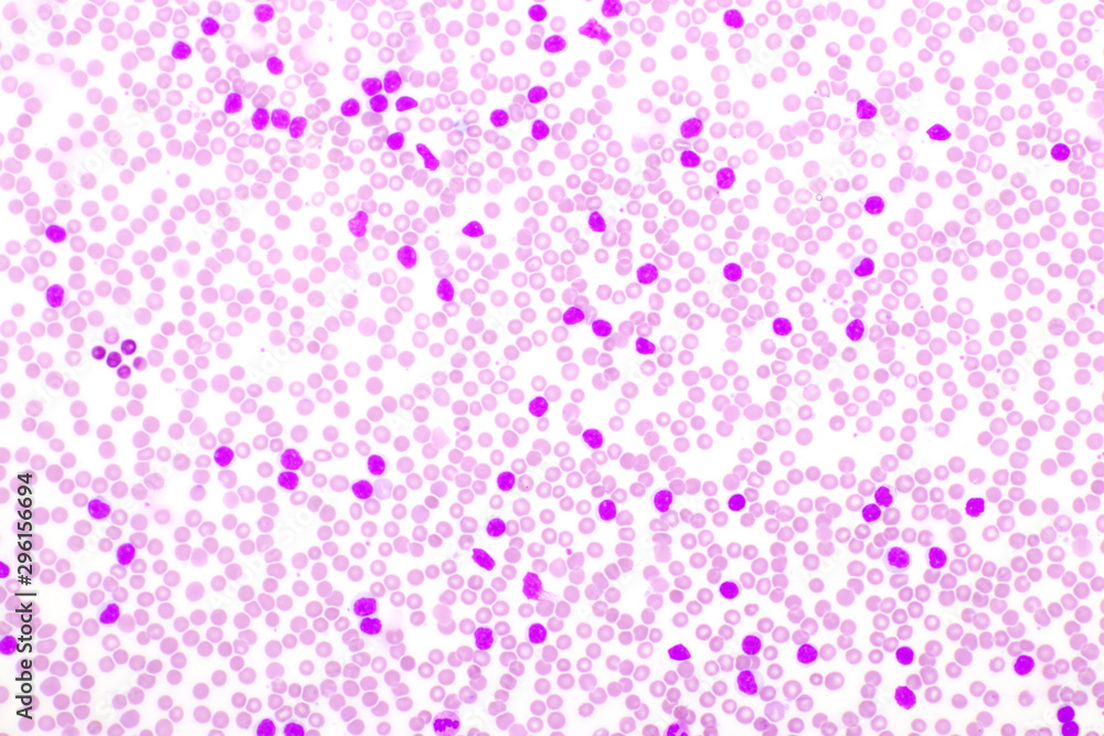Picture of leukemia cells in blood smear, analyze by microscope, 400x Picture of leukemia cells in blood smear, analyze by microscope, 400x