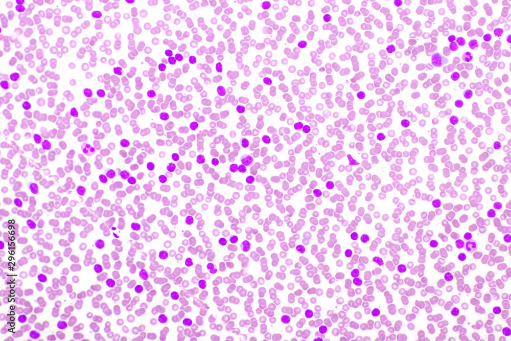 Picture of leukemia cells in blood smear, analyze by microscope, 400x