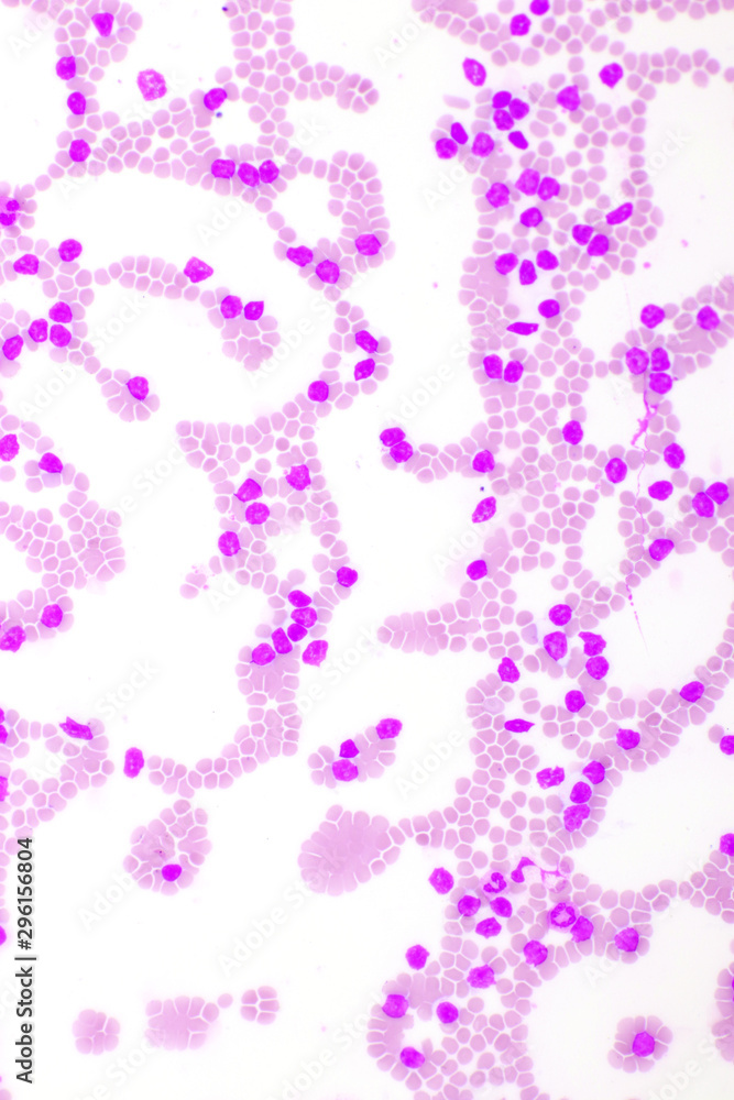 Picture of leukemia cells in blood smear, analyze by microscope, 400x