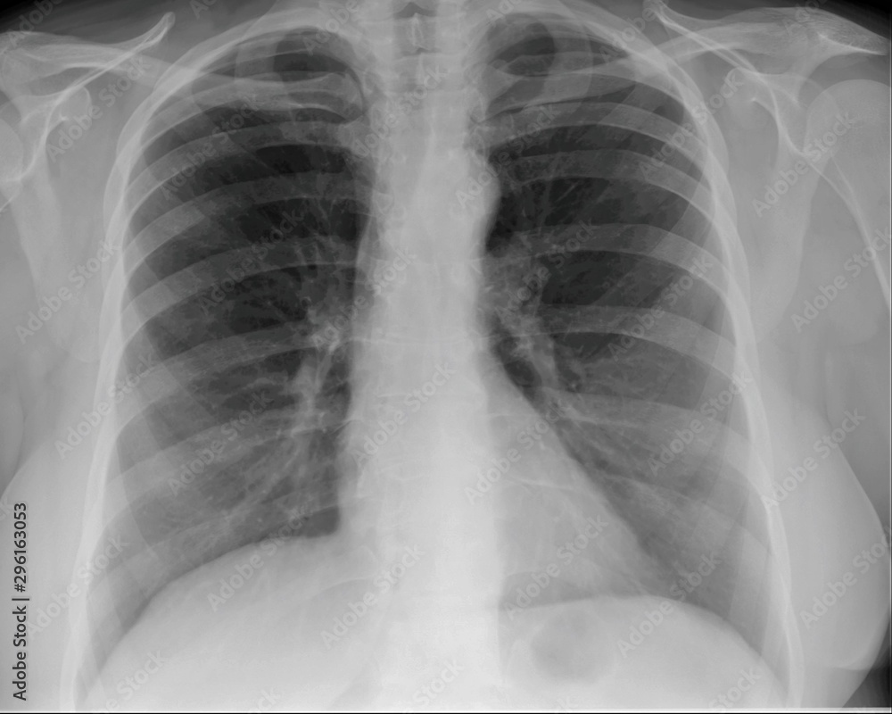 normal radiography of the chest and lungs normal radiography of the chest and lungs