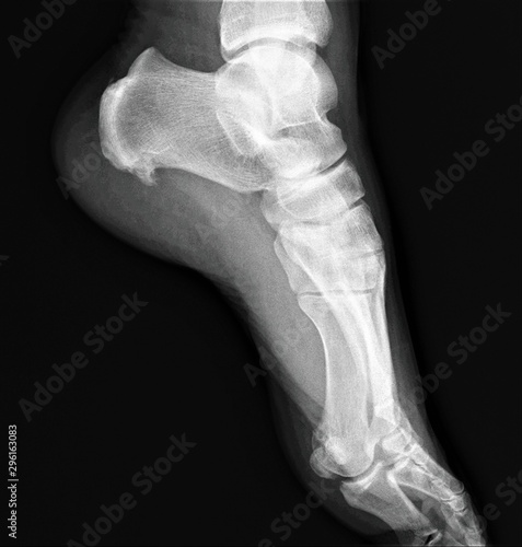heel spur on the x-ray of the right heel bone
