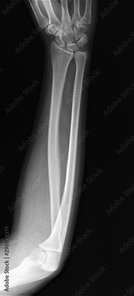 normal radiography of forearm bones with elbow and wrist joints normal radiography of forearm bones with elbow and wrist joints
