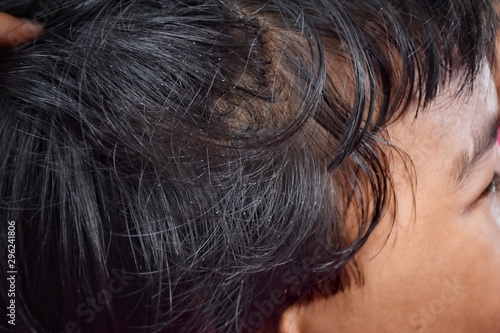 the black hair on the child's head is full of louse egg
