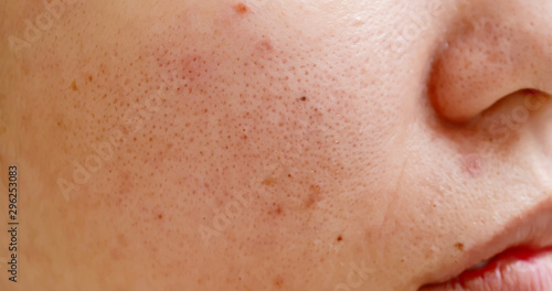 acne on the woman face photo