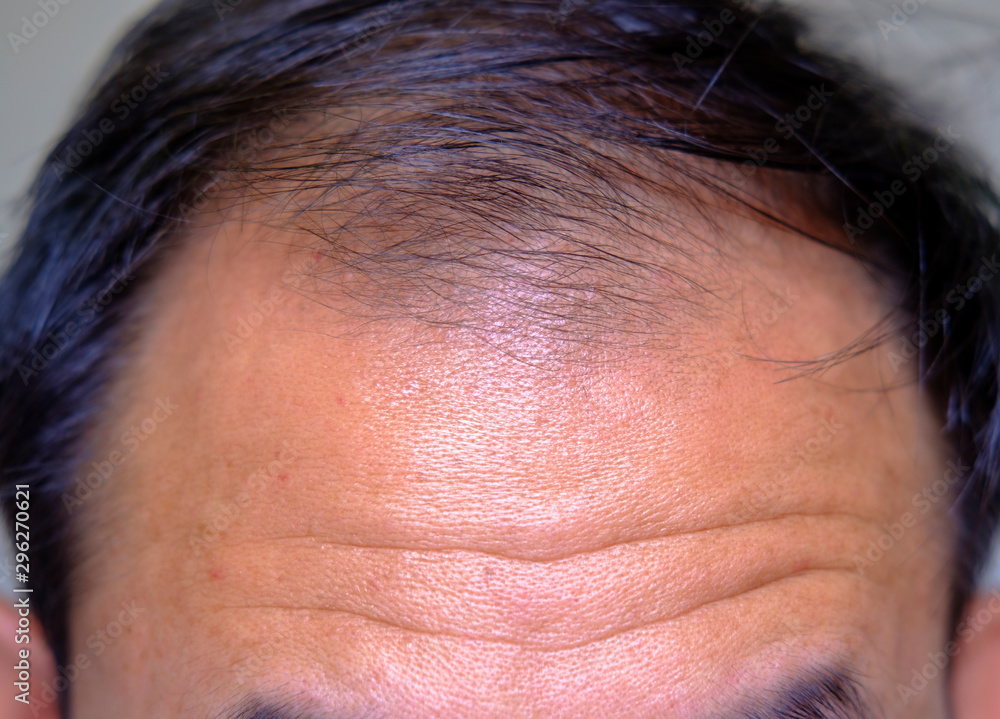 young man of baldness and health and medicine concept young man of baldness and health and medicine concept