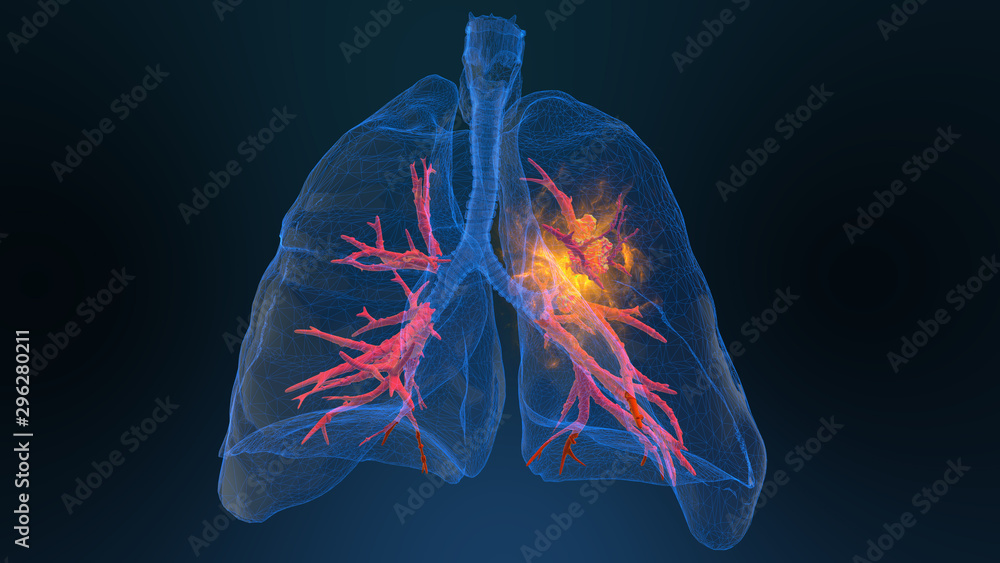 Φωτογραφία 3d rendered illustration of lung cancer 3D illustration