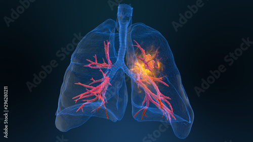 3d rendered illustration of lung cancer 3D illustration