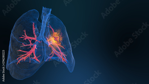 3d rendered illustration of lung cancer 3D illustration