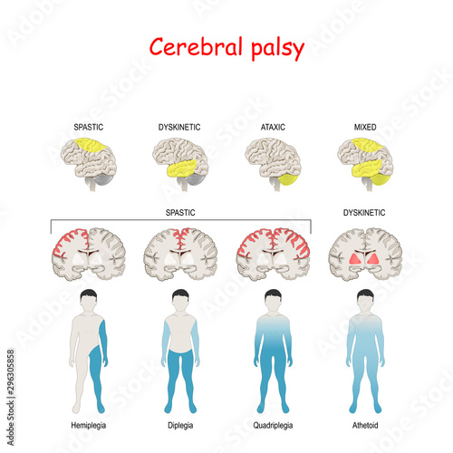 Cerebral palsy. Human brain with area Mixed, Ataxic, Dyskinetic, and Spastic palsy
