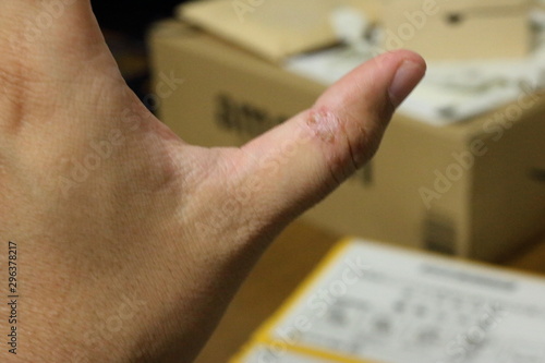 水疱性類天疱瘡