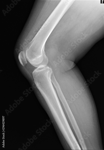 normal x-ray of the knee joint