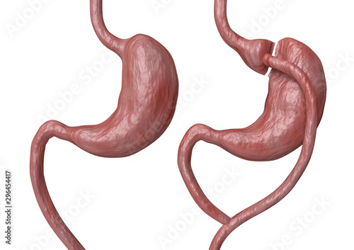 Gastric bypass is a type of bariatric surgery that consists of reducing the stomach and altering the bowel, leading to a marked loss of body weight photo