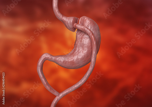 Gastric bypass is a type of bariatric surgery that consists of reducing the stomach and altering the bowel, leading to a marked loss of body weight photo
