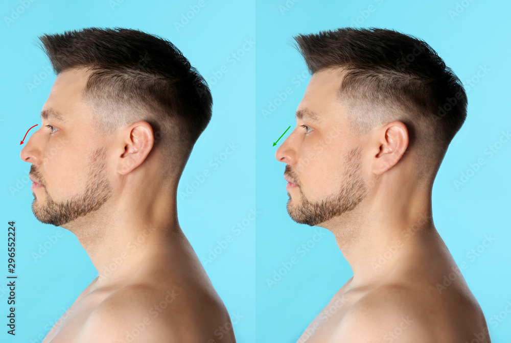 Fototapeta premium Man before and after plastic surgery on light blue background