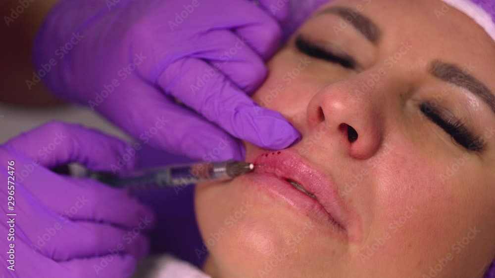 Lip injection plastic surgery. Close up of lips of patient during lip augmentation Lip injection plastic surgery. Close up of lips of patient during lip augmentation
