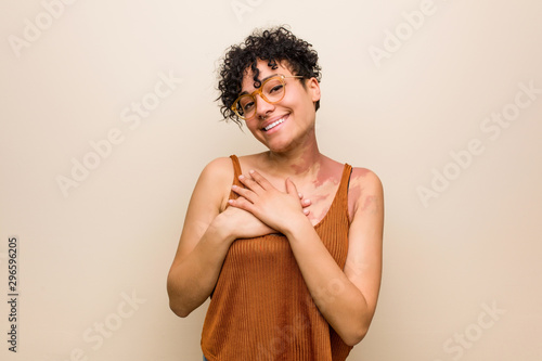 Young african american woman with skin birth mark has friendly expression, pressing palm to chest. Love concept.