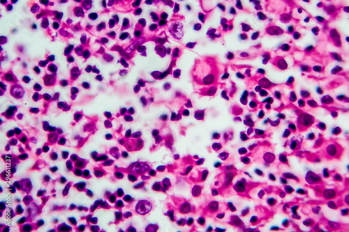 Hodgkin's lymphoma, light micrograph, photo under microscope photo