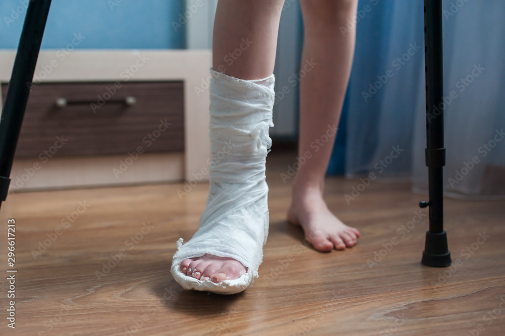 Broken leg in plaster and crutches