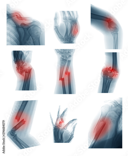 Collection X-ray image showing upper limb or uper extremity fractures photo