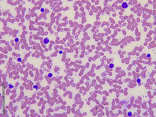 Blood smear of a patient with infections mononucleosis.