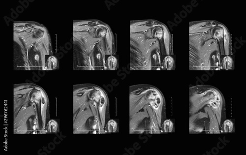 Magnetic resonance imaging (MRI scan) of shoulder Joint pain, coronal view