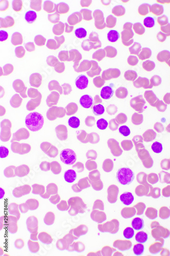 Blood picture of chronic lymphocytic leukemia or CLL, analyze by microscope, original magnification 400x