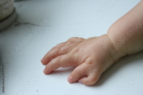  Polydactyly  Preaxial, Polydactyly on human; rare abnormal characteristic causes by chromosome, Disorders of Hands, six fingers in one hands