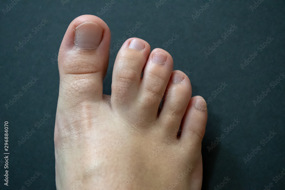 Webbed toes, syndactyly affecting the feet, fusion of two or more digits of  the feet. Twin toes, mutation. Stock-Foto | Adobe Stock