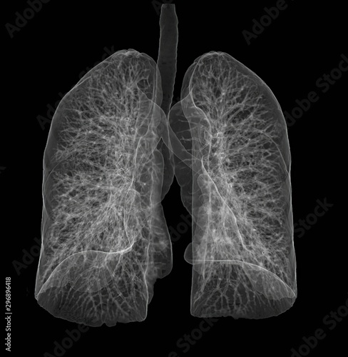 CT 3D SCAN of the lungs.