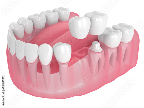 3d render of jaw with dental cantilever bridge photo
